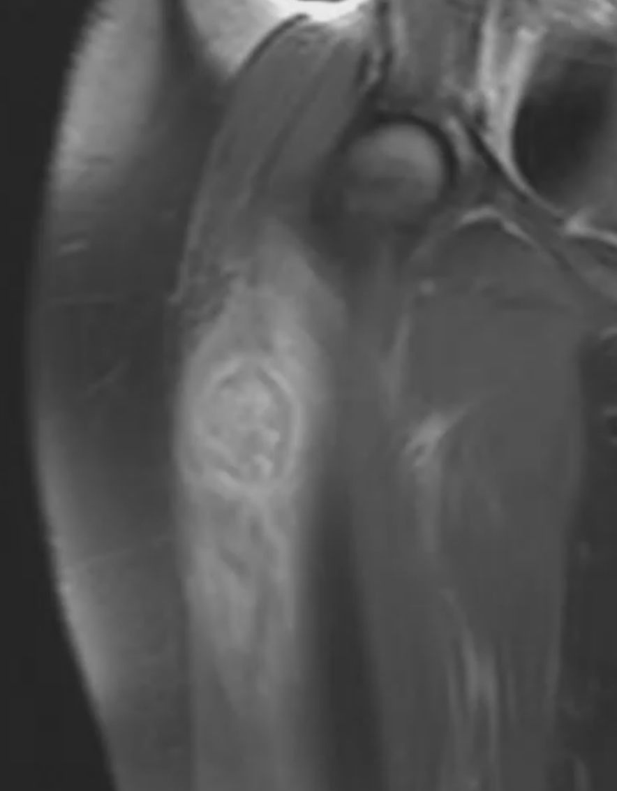 Miosite ossificante - RM T1 GD coronal miosite ossificante subaguda Miosite ossificante - RM T1 GD coronal miosite ossificante subaguda