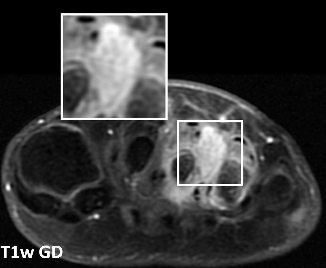 Miosite ossificante - T1 gd Miosite ossificante - T1 gd