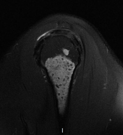 Encondroma - T2 sag Encondroma - T2 sag
