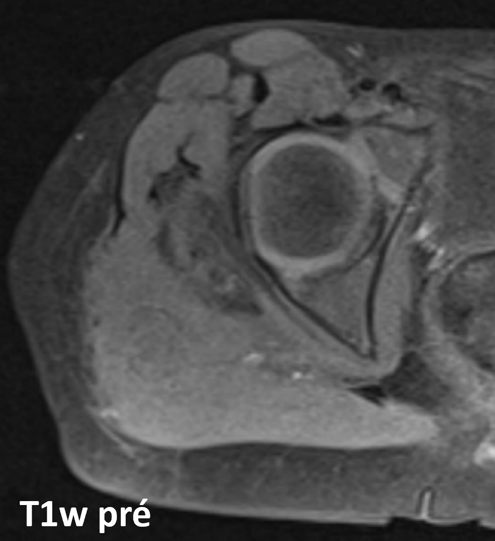 Miosite ossificante - axial t1 Miosite ossificante - axial t1