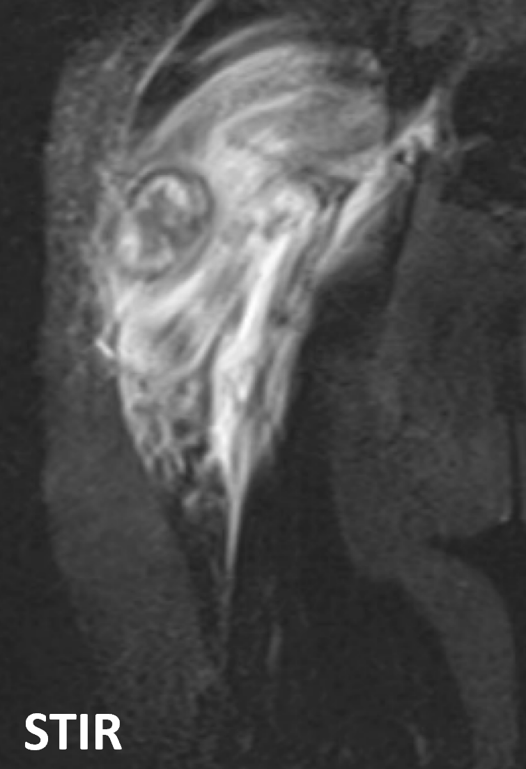 Miosite ossificante - coronal stir Miosite ossificante - coronal stir