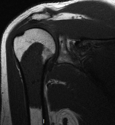 Encondroma - t1 2 Encondroma - t1 2