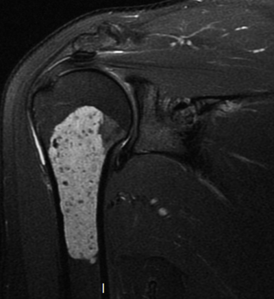 Encondroma - t2 2 Encondroma - t2 2