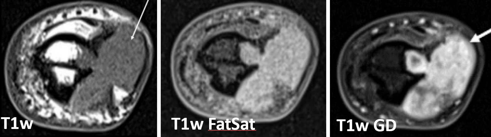 Condroma periosteal (justacortical) - axiais T1 T1 fatsat e T1 gd