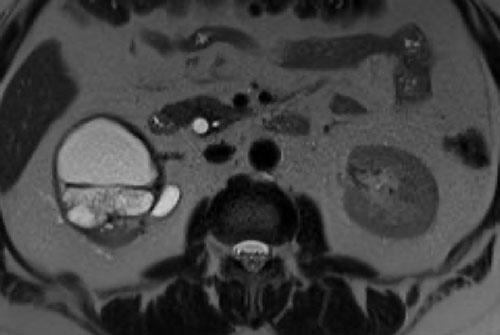 Cisto renal / Classificação de Bosniak - Bosniak2 septos sem realce 01 Cisto renal / Classificação de Bosniak - Bosniak2 septos sem realce 01
