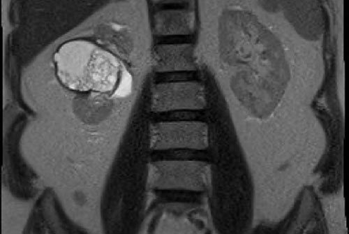Cisto renal / Classificação de Bosniak - Bosniak2 septos sem realce 02 Cisto renal / Classificação de Bosniak - Bosniak2 septos sem realce 02
