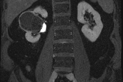 Cisto renal / Classificação de Bosniak - Bosniak2 septos sem realce 03 Cisto renal / Classificação de Bosniak - Bosniak2 septos sem realce 03