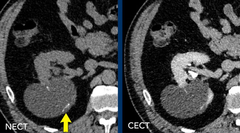 Cisto renal / Classificação de Bosniak - BosniakI TC calcificacoes Cisto renal / Classificação de Bosniak - BosniakI TC calcificacoes