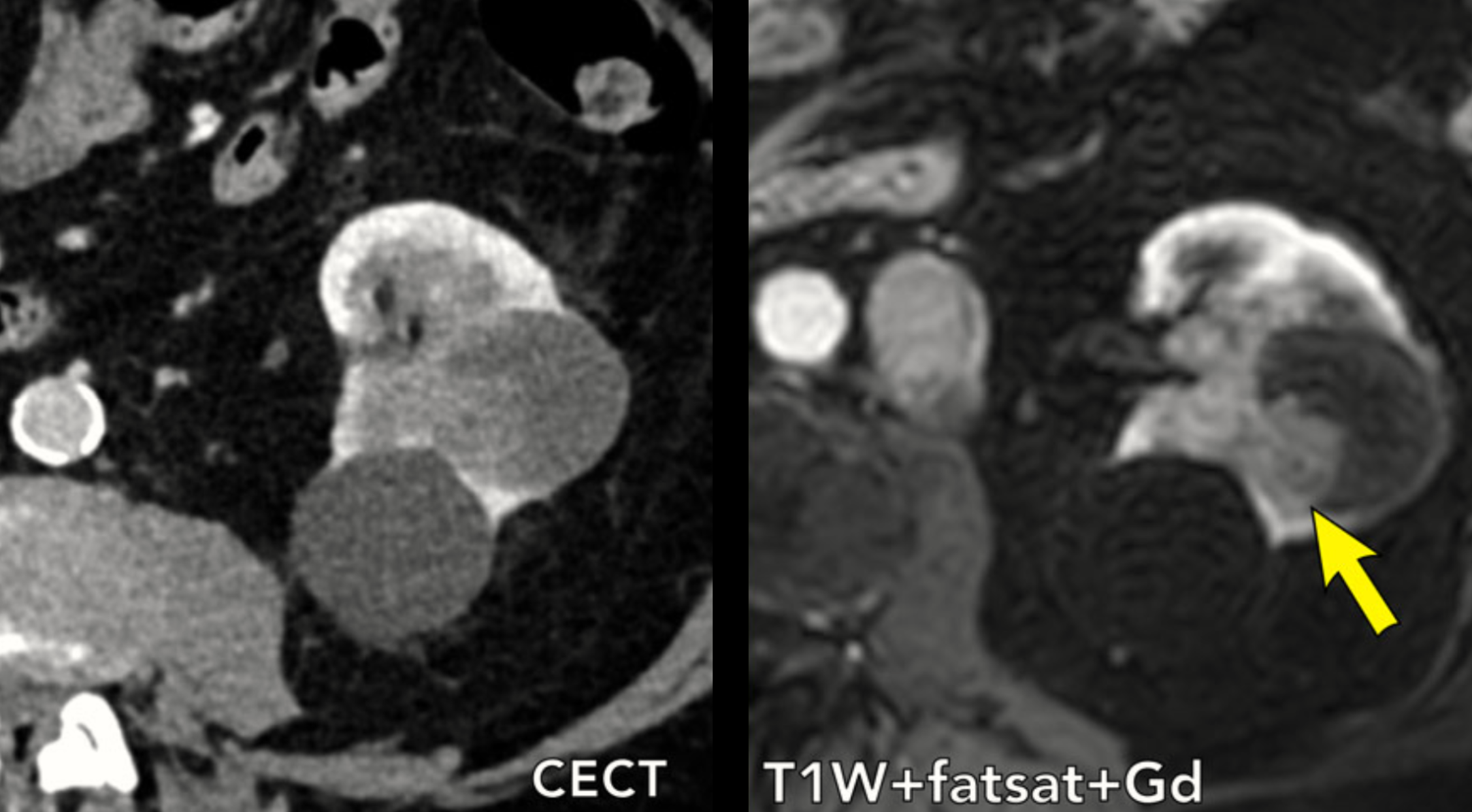 Cisto renal / Classificação de Bosniak - b4 Cisto renal / Classificação de Bosniak - b4