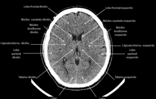 Anatomia: TC de CRÂNIO - Slide123 e1694295057635