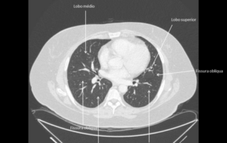 Anatomia: TC de TÓRAX - Slide28 e1694298692249