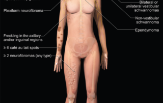 Neurofibromatose tipos 1 e 2 - 1