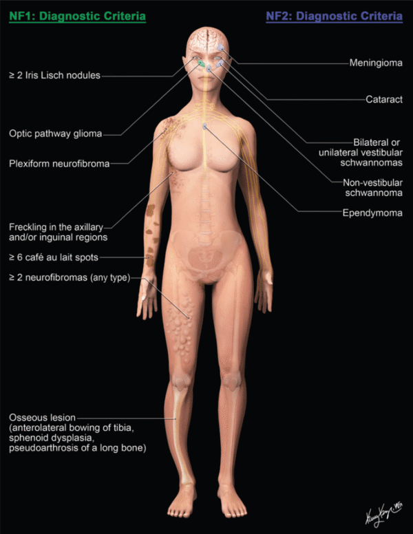 Neurofibromatose tipos 1 e 2 - 1 neurofibromatose