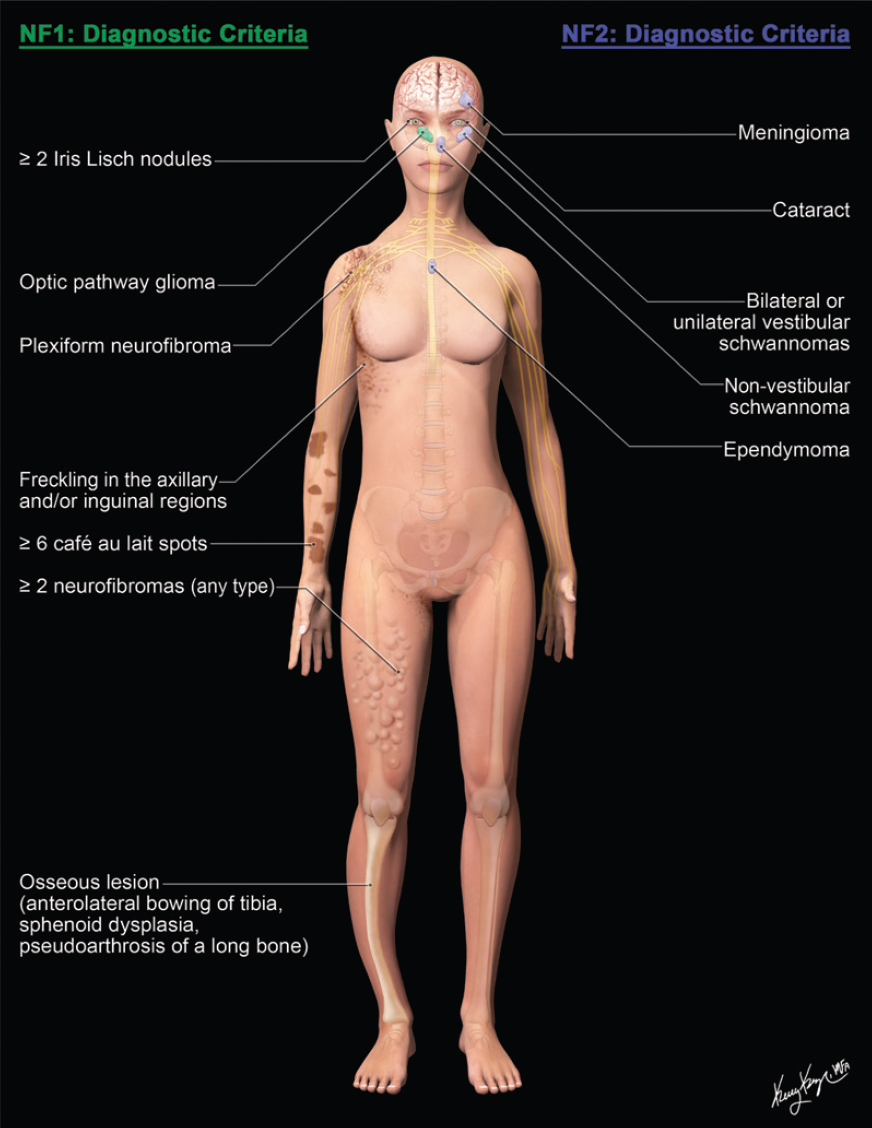 Neurofibromatose tipos 1 e 2 - 1