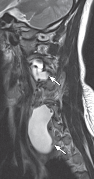 Neurofibromatose Tipo 1 - Doença de von Recklinghausen - 10