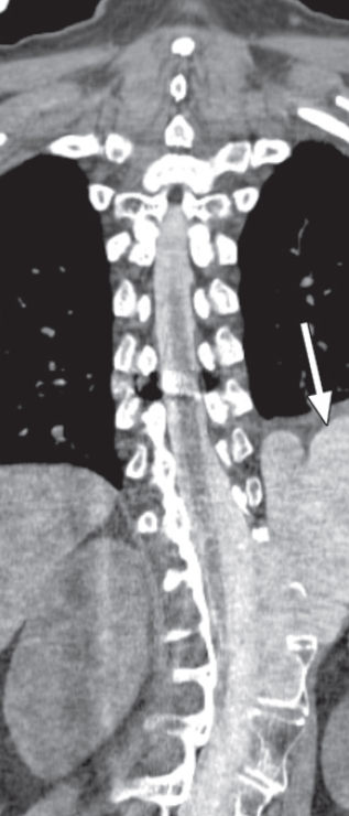 Neurofibromatose Tipo 1 - Doença de von Recklinghausen - 11