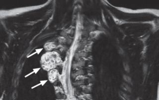 Neurofibromatose Tipo 1 - Doença de von Recklinghausen - 12