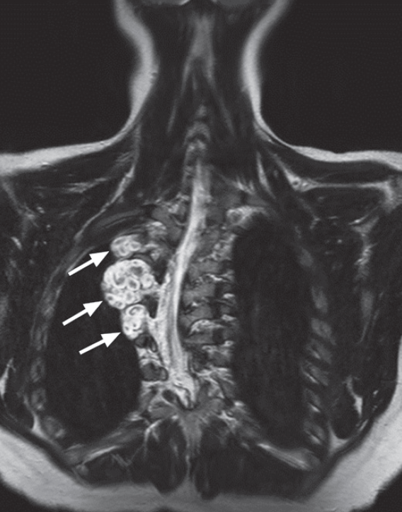Neurofibromatose Tipo 1 - Doença de von Recklinghausen - 12
