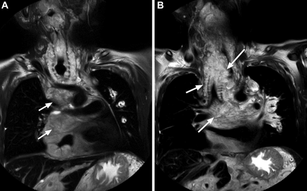 Neurofibromatose Tipo 1 - Doença de von Recklinghausen - 13