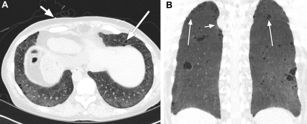 Neurofibromatose Tipo 1 - Doença de von Recklinghausen - 15