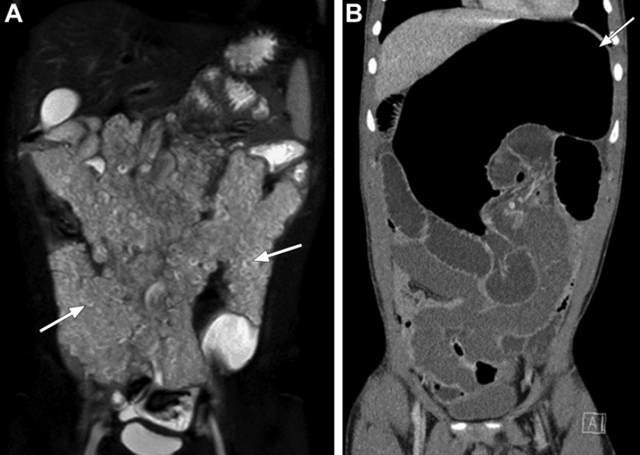Neurofibromatose Tipo 1 - Doença de von Recklinghausen - 16