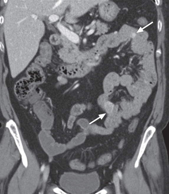 Neurofibromatose Tipo 1 - Doença de von Recklinghausen - 17