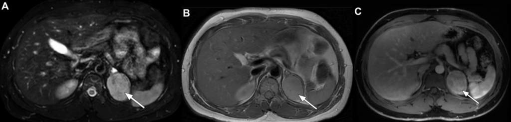 Neurofibromatose Tipo 1 - Doença de von Recklinghausen - 18