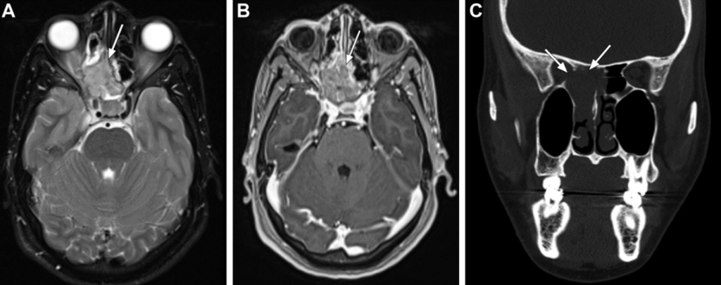 Neurofibromatose Tipo 1 - Doença de von Recklinghausen - 19