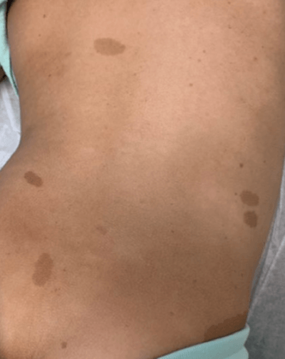 Neurofibromatose Tipo 1 - Doença de von Recklinghausen - 2