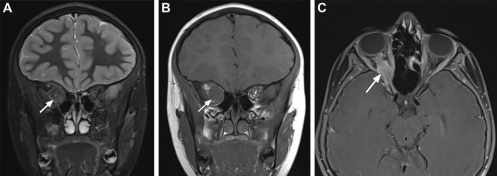 Neurofibromatose Tipo 2 - 23 Neurofibromatose Tipo 2 - 23