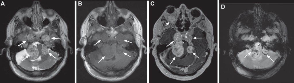 Neurofibromatose tipos 1 e 2 - 24 Neurofibromatose tipos 1 e 2 - 24
