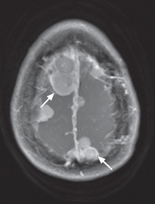 Neurofibromatose tipos 1 e 2 - 27 Neurofibromatose tipos 1 e 2 - 27
