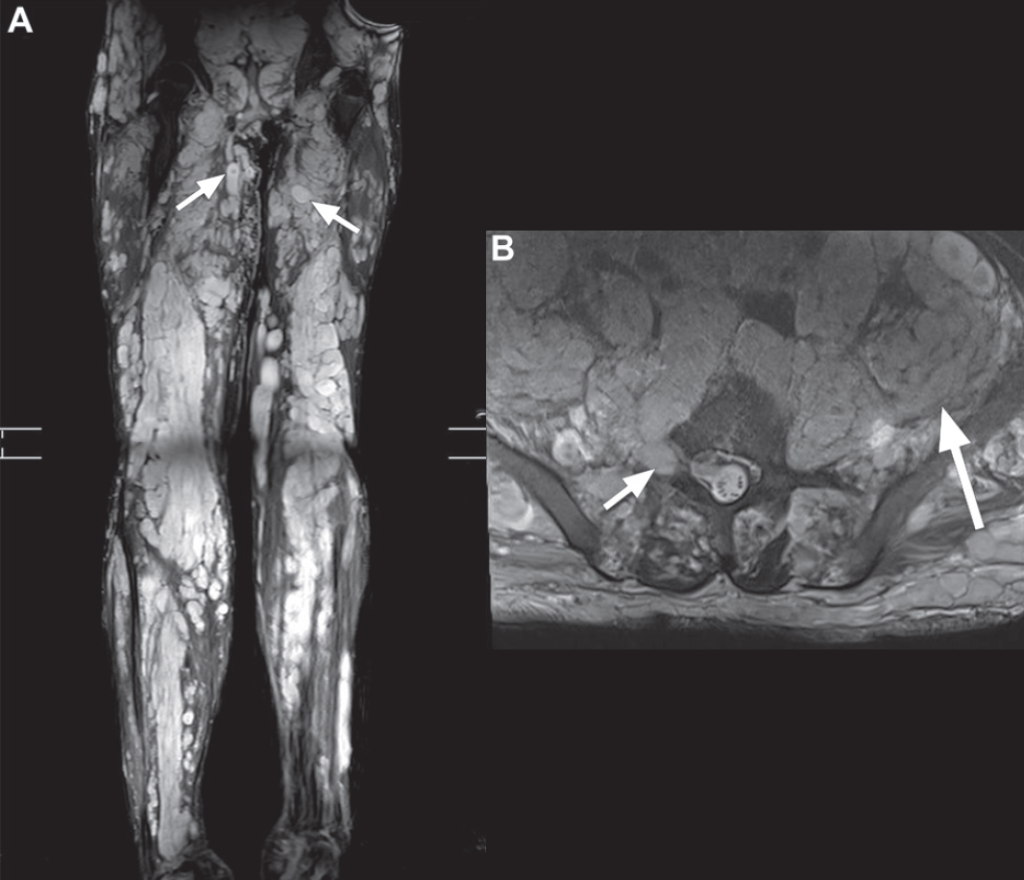 Neurofibromatose Tipo 1 - Doença de von Recklinghausen - 3