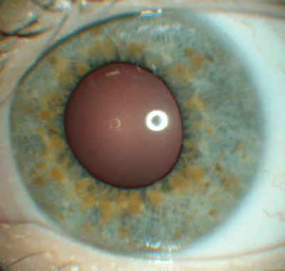 Neurofibromatose Tipo 1 - Doença de von Recklinghausen - 4