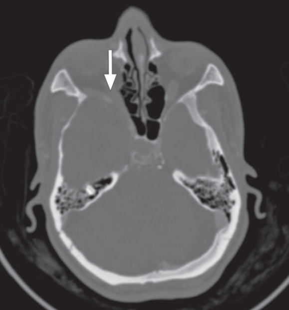 Neurofibromatose Tipo 1 - Doença de von Recklinghausen - 5