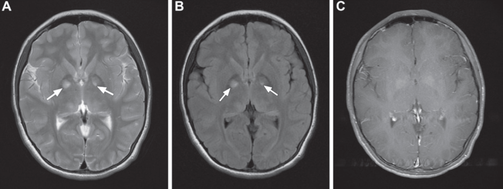 Neurofibromatose Tipo 1 - Doença de von Recklinghausen - 6