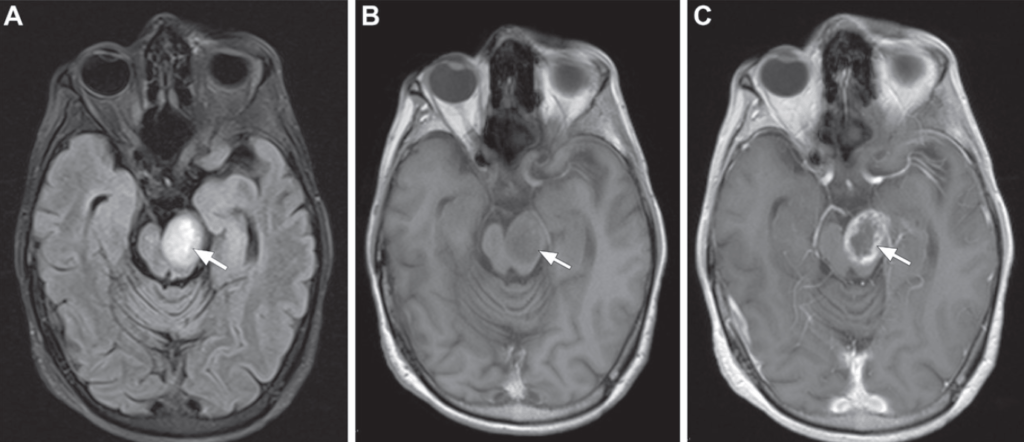 Neurofibromatose Tipo 1 - Doença de von Recklinghausen - 8